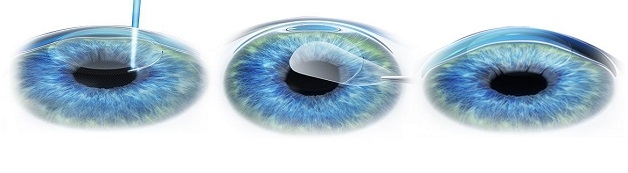 phẫu thuật tật khúc xạ smile