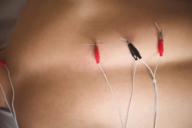 Thoát vị đĩa đệm vật lý trị liệu bằng xung điện