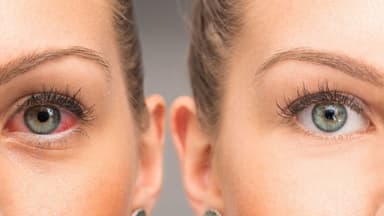 Tiêu chí lựa chọn các loại thuốc bổ mắt cho người bị glôcôm