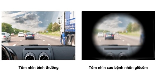 Người bệnh có thể mất hoàn toàn thị lực nếu mắc bệnh glocom