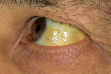 Triệu chứng u gan ác tính giai đoạn 3 và cách điều trị