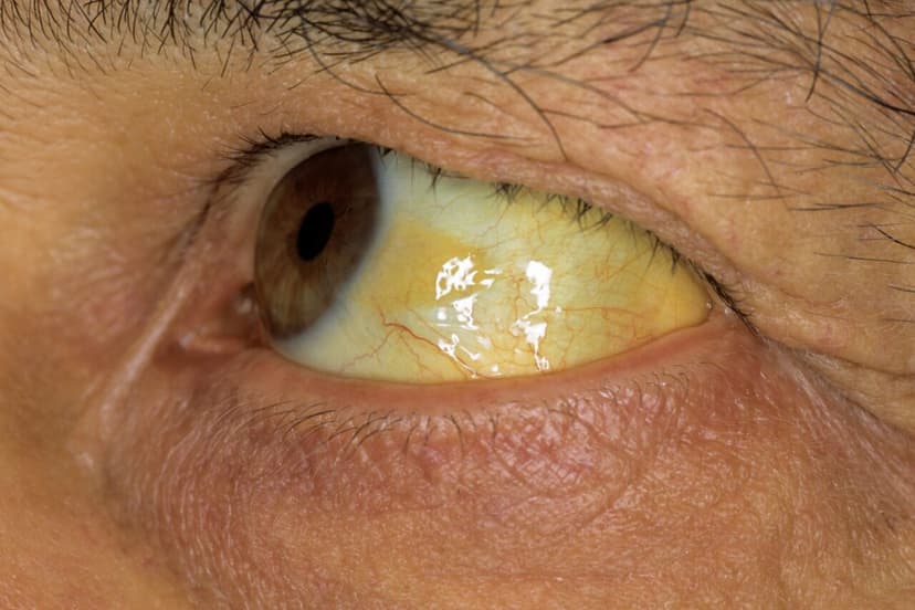 Triệu chứng u gan ác tính giai đoạn 3 và cách điều trị