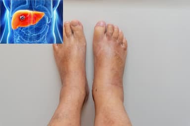 Ung thư gan bị phù chân và giải pháp chăm sóc