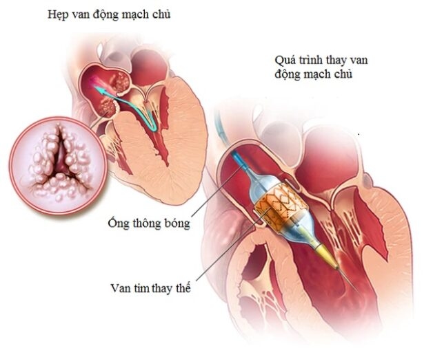 Thủ thuật can thiệp nội mạch