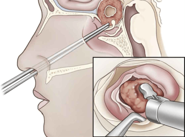 Điều trị u tuyến yên nhằm đảm bảo hoạt động của tuyến yên