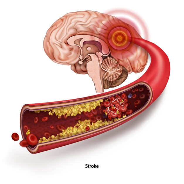 Đột quỵ gia tăng ở người trẻ do xơ vữa động mạch