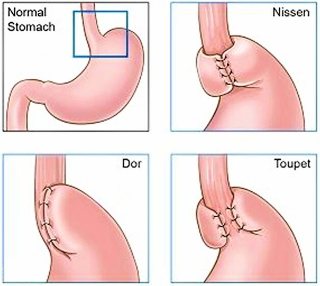 Phẫu thuật trào ngược dạ dày thực quản