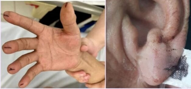 Không chích đầu ngón tay khi người bệnh bị đột quỵ