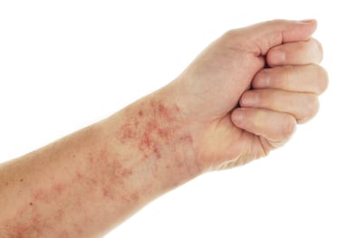 Tìm hiểu các biểu hiện xảy ra ở bệnh nhân ung thư máu