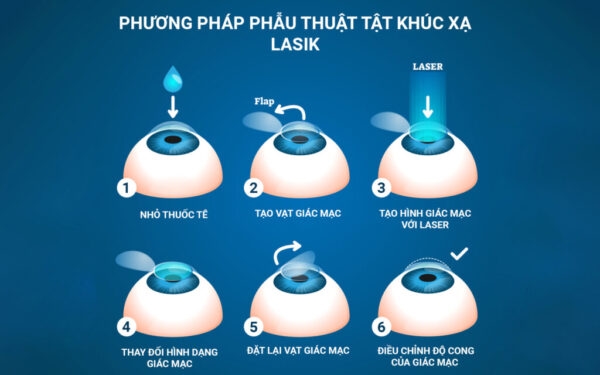 Các phương pháp điều trị tật khúc xạ bằng laser excimer: Lasik
