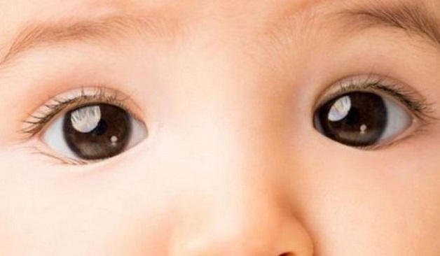 Nguyên nhân gây lác mắt