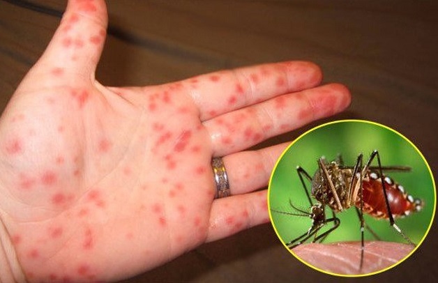 Sốt xuất huyết là bệnh do virus Dengue gây ra và tiềm ẩn nhiều nguy hiểm.