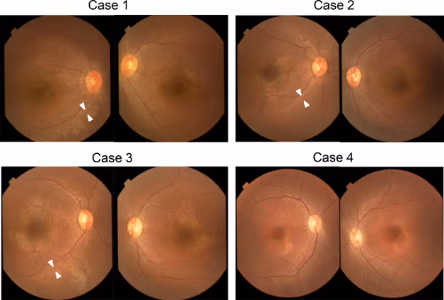 viêm thị thần kinh leber