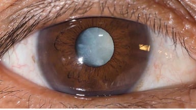 Nắm rõ 3 điều cần biết về thuốc tăng nhãn áp Lumigan