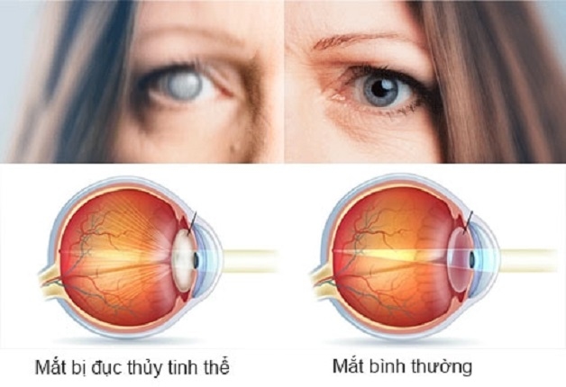 Đục thủy tinh thể