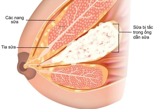 Tắc ống dẫn sữa