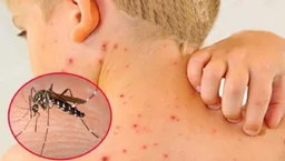 Đặc điểm giai đoạn 2 của sốt xuất huyết