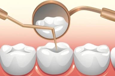 Trám răng thẩm mỹ bao nhiêu tiền và các yếu tố ảnh hưởng