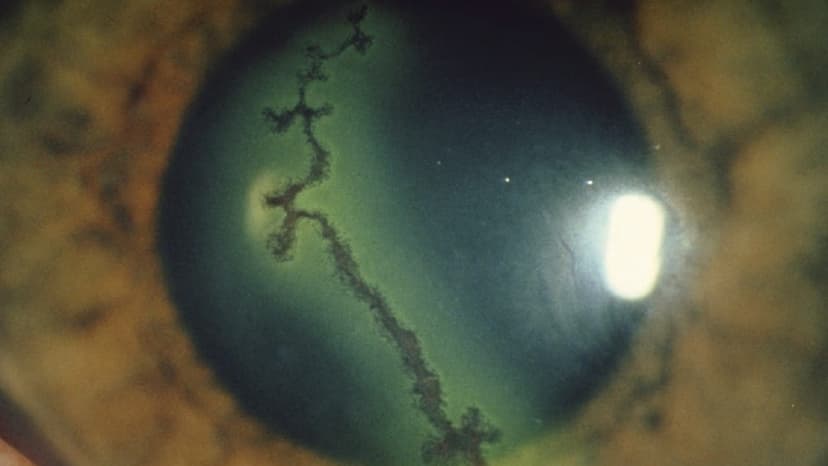 Viêm loét giác mạc hình cành cây: Nguyên nhân và triệu chứng