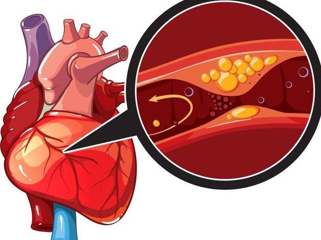 bệnh tim do thiếu máu cục bộ