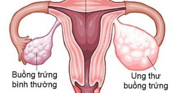 bệnh ung thư buồng trứng là gì?