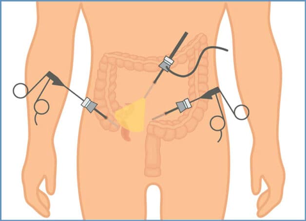 Phẫu thuật được coi là phương pháp chữa trị chính cho đau ruột thừa