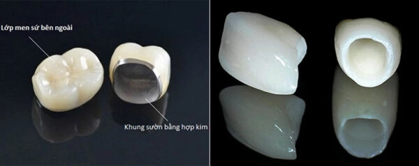 điều cần biết khi bọc sứ 6 răng cửa