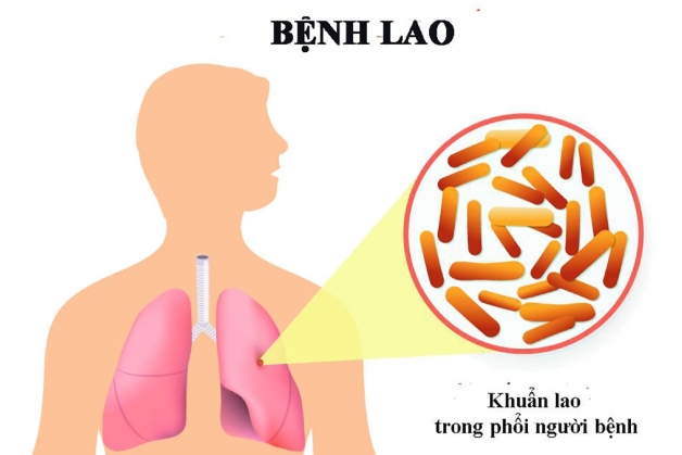 vacxin phòng bệnh lao