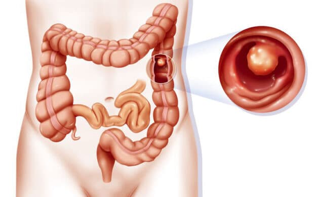 Polyp gây nguy cơ ung thư tại đại tràng