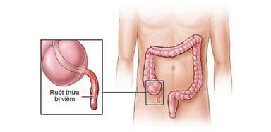 Nhận biết các triệu chứng của bệnh đau ruột thừa