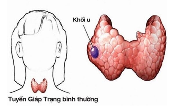 Hình ảnh u tuyến giáp lành tính