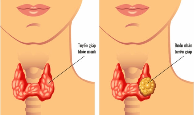 Tuyến giáp to là triệu chứng của bướu giáp đơn thuần