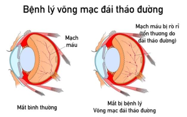Bệnh võng mạc đái tháo đường là biến chứng dễ gặp ở người mắc tiểu đường