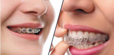 Cập nhật bảng giá niềng răng mới nhất