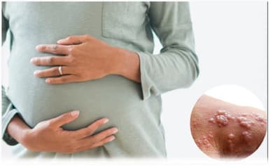 Những loại thuốc có thể sử dụng cho mẹ bầu bị đậu mùa khỉ