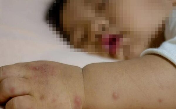 Trẻ bị tay chân miệng bao lâu thì khỏi-2