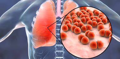 6 Bệnh đường hô hấp dễ mắc khi giao mùa