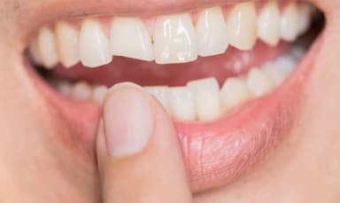 Bọc răng sứ 2 răng cửa giá bao nhiêu và độ hiệu quả