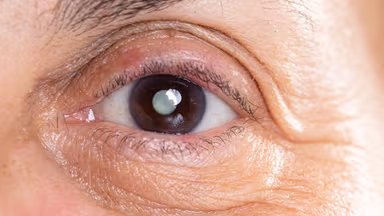 Bong võng mạc mắt trái có thể gây mất thị lực vĩnh viễn