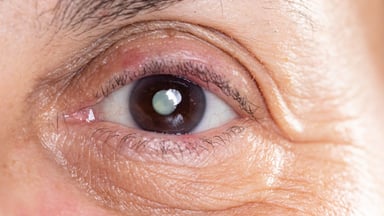 Bong võng mạc mắt trái có thể gây mất thị lực vĩnh viễn