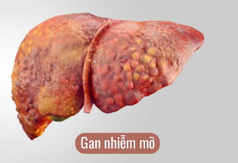 Hiểu đúng về các chỉ số gan nhiễm mỡ trong xét nghiệm máu