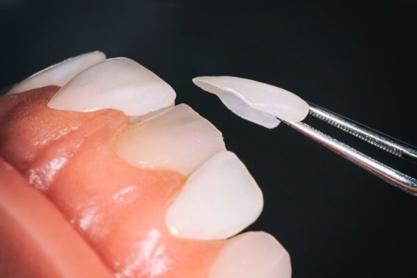 Răng sứ Lumineer Veneer (cực mỏng và chân thật)