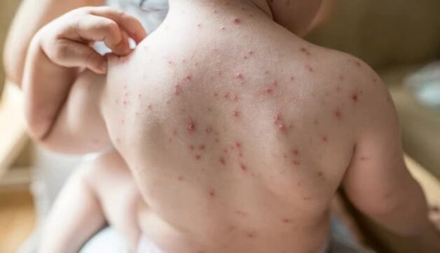 Đâu là Cách chữa bệnh thủy đậu nhanh nhất