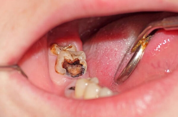 Sâu răng lồi thịt là tình trạng gì?