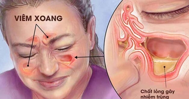 cách điều trị viêm xoang mãn tính như thế nào