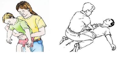 Hướng dẫn cách sơ cứu khi bị hóc dị vật