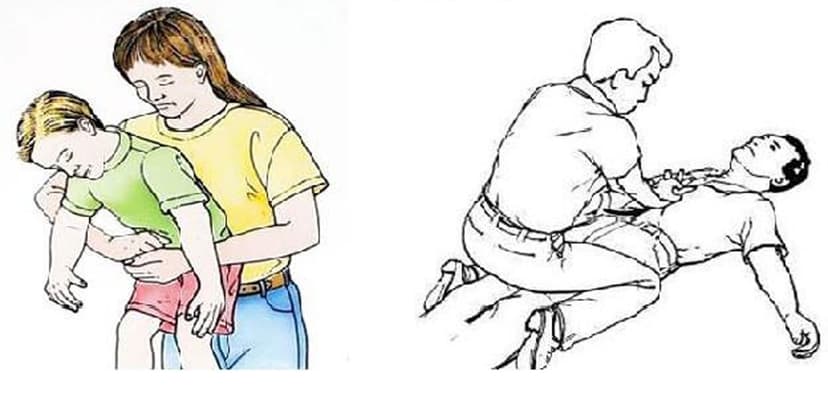 Hướng dẫn cách sơ cứu khi bị hóc dị vật