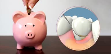 Lưu ý khi lựa chọn cạo vôi răng giá rẻ