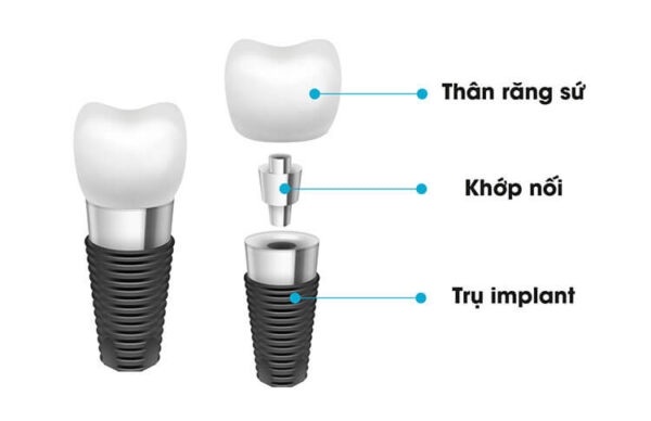 Cấy ghép răng Implant bao nhiêu tiền hiện nay?