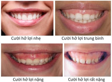 Hiệu quả của chữa cười hở lợi bằng niềng răng